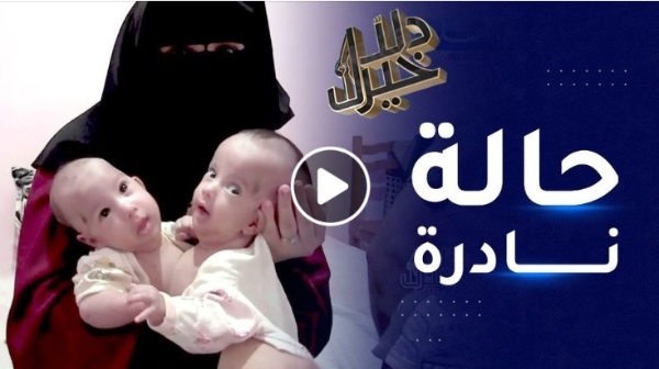 توأم بجسد واحد في حالة نادرة الحدوث وأمهم تناشد المحسنين وذوي الإختصاص للنظر في حالتهم