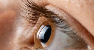 انفصال الشبكية أسبابه، أعراضه، وأهمية العلاج المبكر للحفاظ على صحة العين